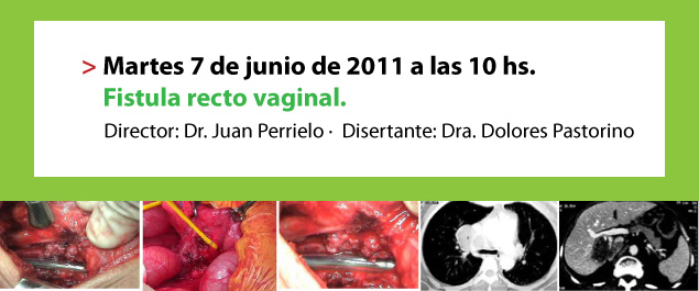 Fistula recto vaginal