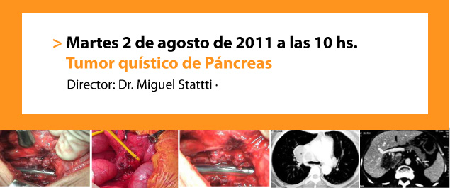 Tumor quístico de Páncreas